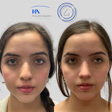 Slider image (4) Dr. Guillermo Guerra Gil de Leyva - Rhinoplasty Specialist